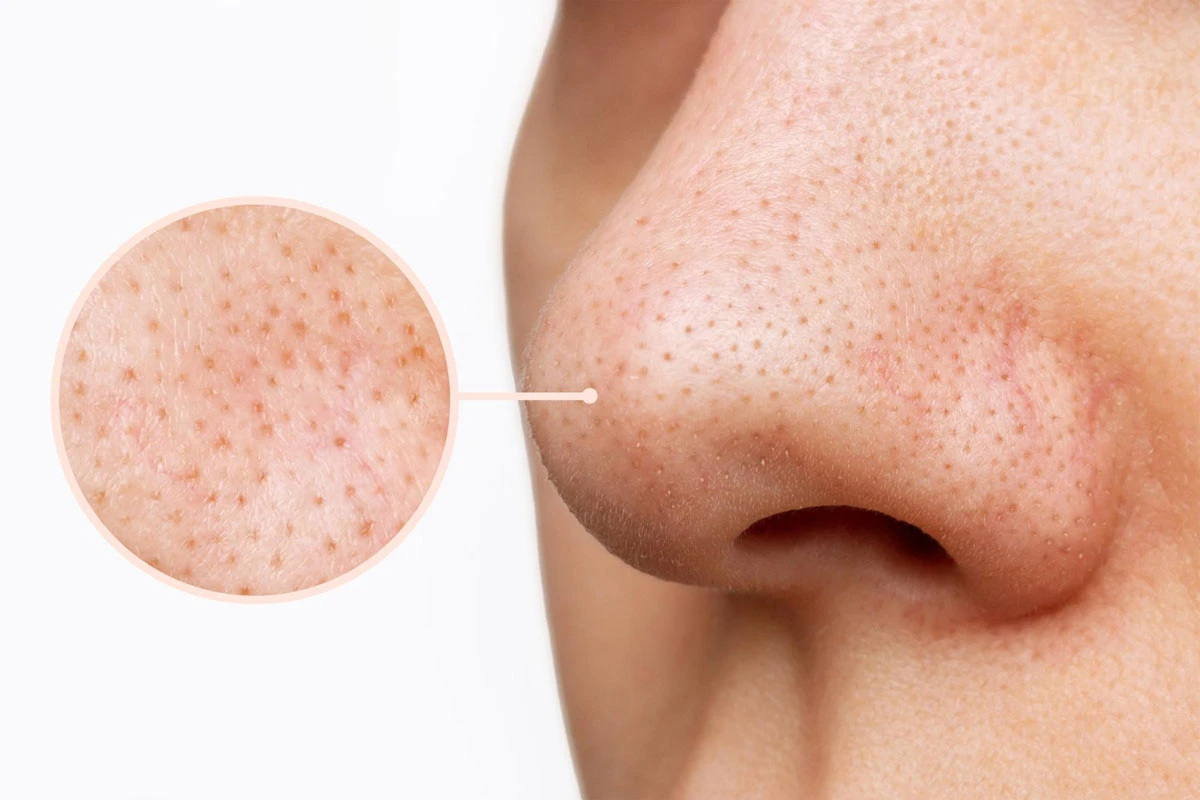 quale microneedling scegliere per post-acne pori e texture cutanea irregolare