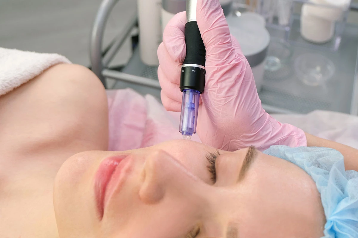 Come funziona il microneedling classico e quando prenderlo in considerazione