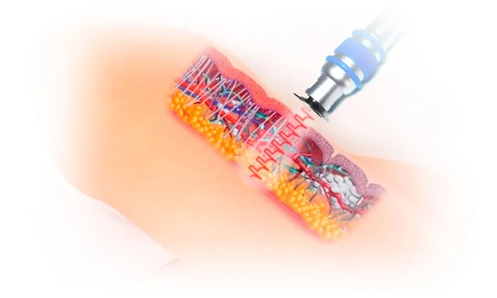 Come Si Svolge la Terapia con Onde d'Urto