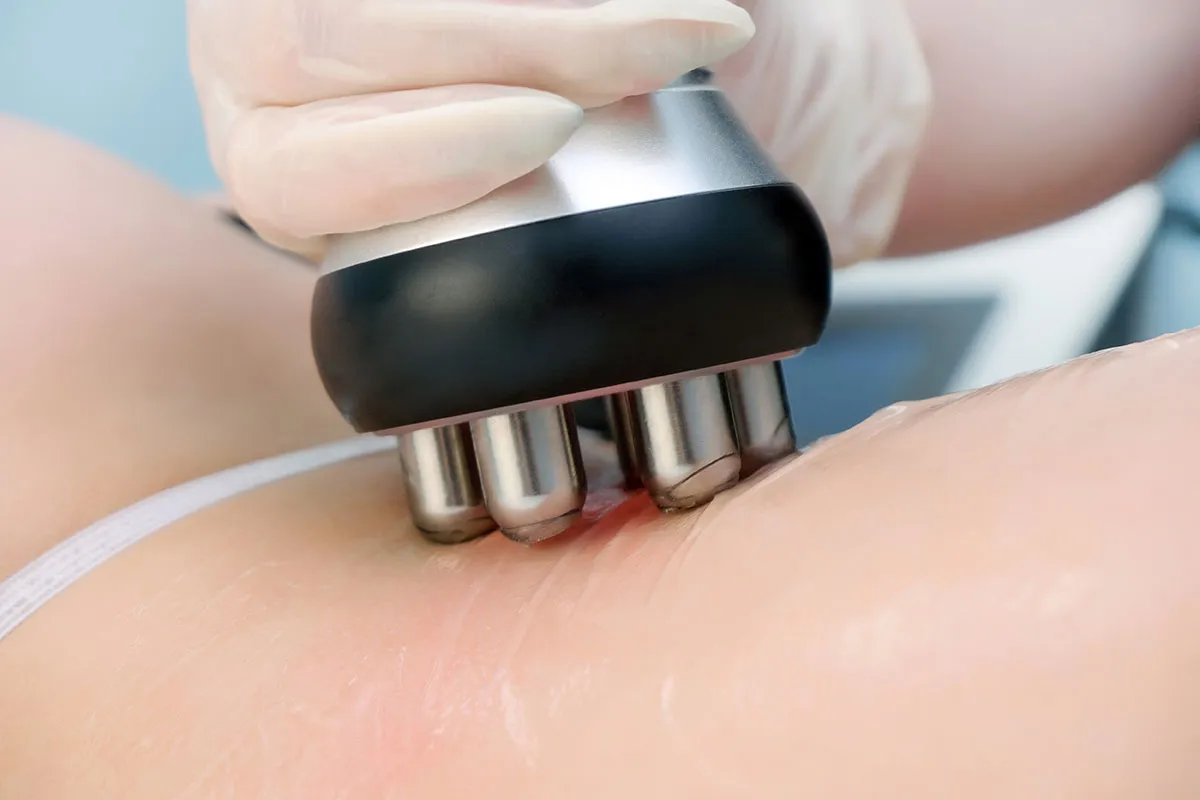 come presentare efficacemente la procedura di rf-lifting ai clienti